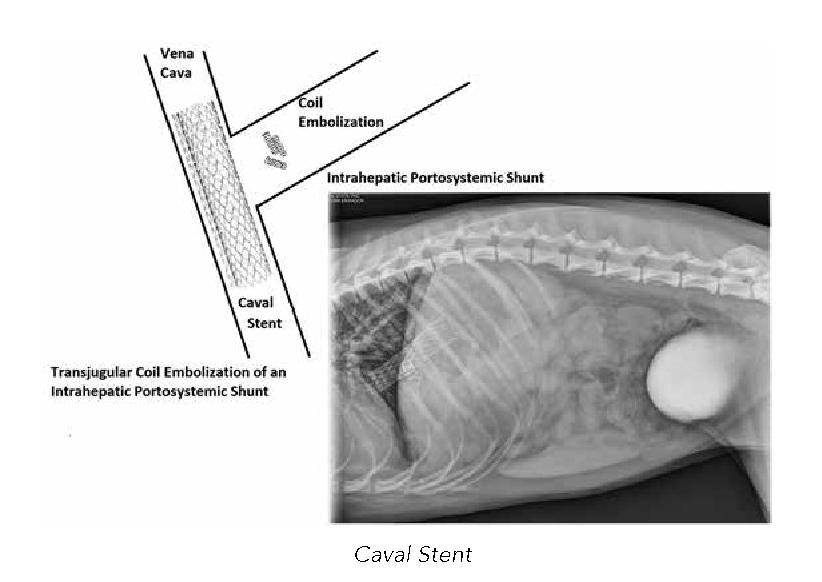 Caval Stent