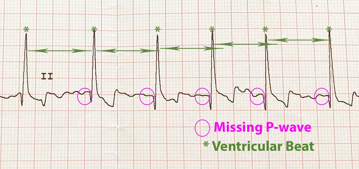 EKG Showing AFib