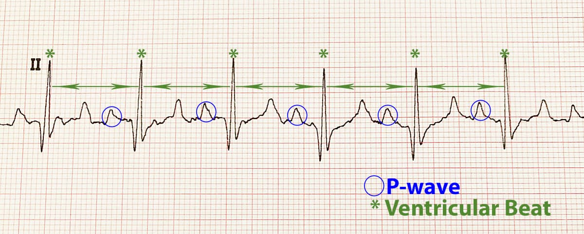 Normal EKG