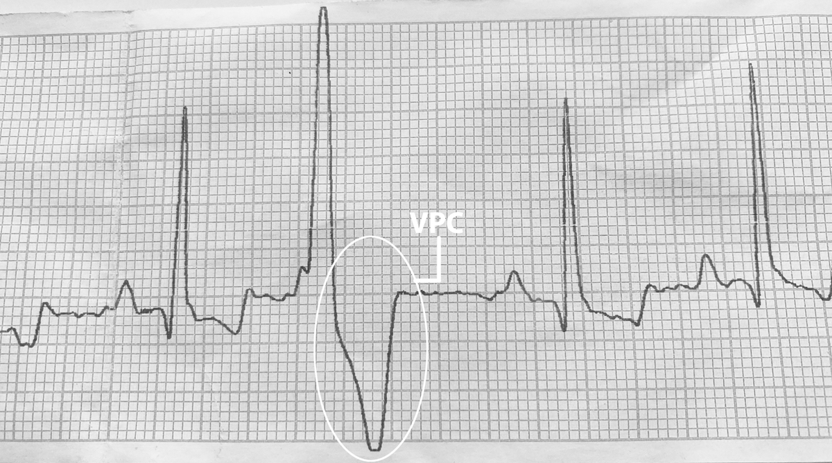 IW EKG Showing VPC