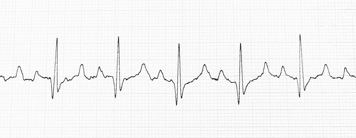 Normal IW EKG