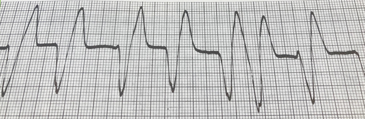 IW EKG Showing VTach